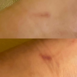 Im oberen Teil Bild von einer Narbe nach 1 Monat Behandlung mit Narbenöl, unten vor der Behandlung